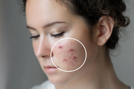 Get rid of Acne | Acne Treatment Cost | Best Acne Tablets in Pakistan